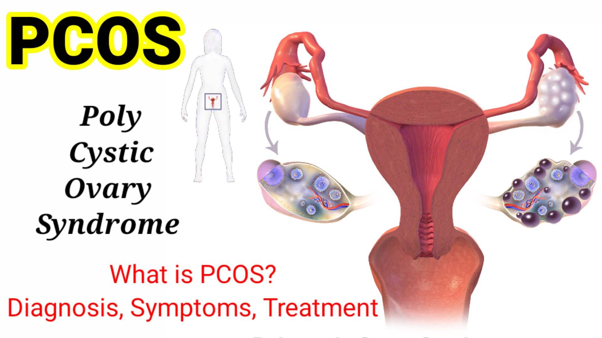 What is PCOS : it’s Definition, Diagnosis, Symptoms and Treatment