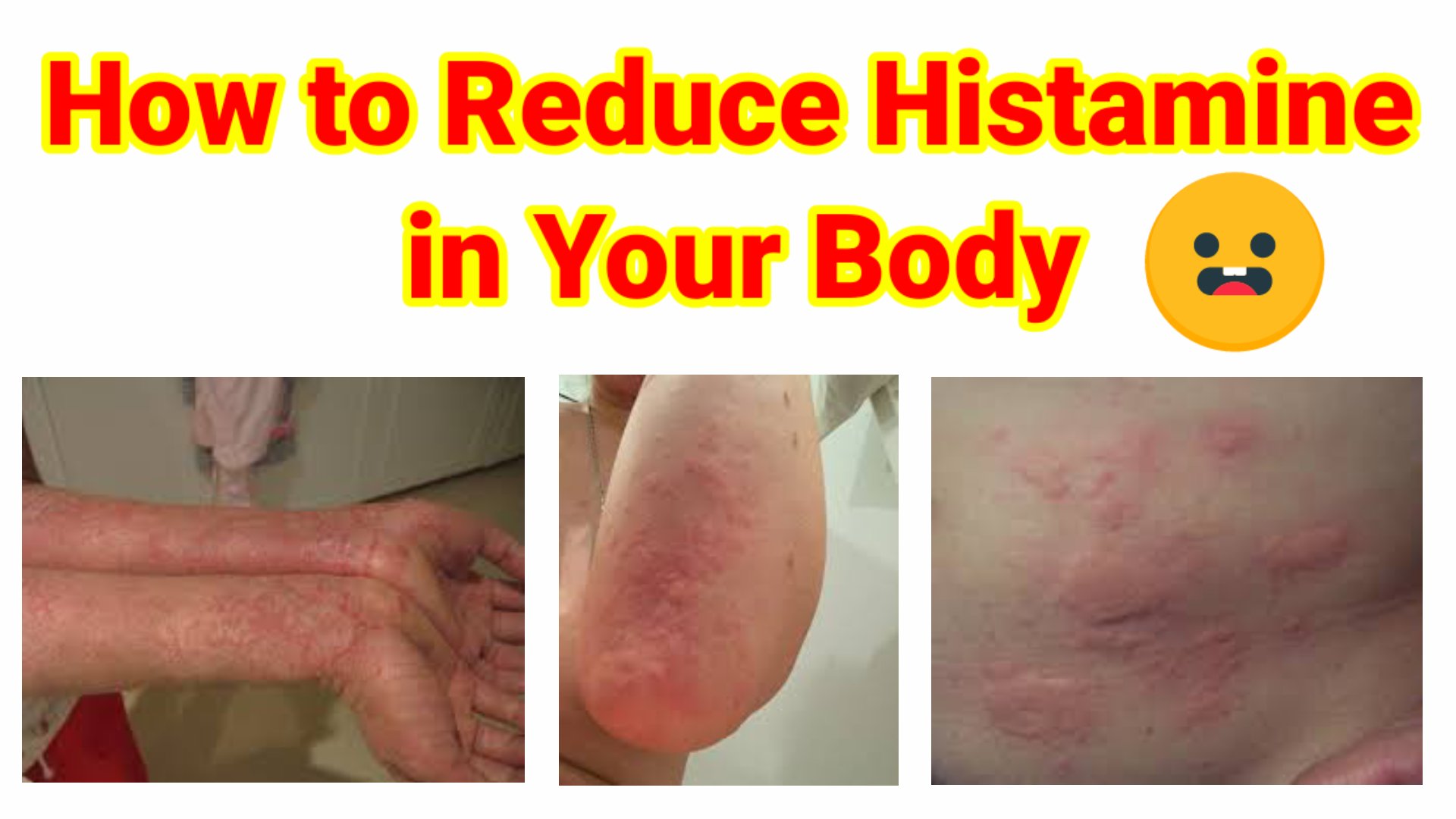 How to Reduce Histamine in Your Body